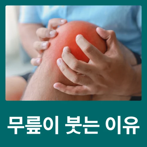 창신동정형외과 무릎이 붓는 이유와 동묘·동묘역앞·신설동·동대문·보문동 무릎통증 정보